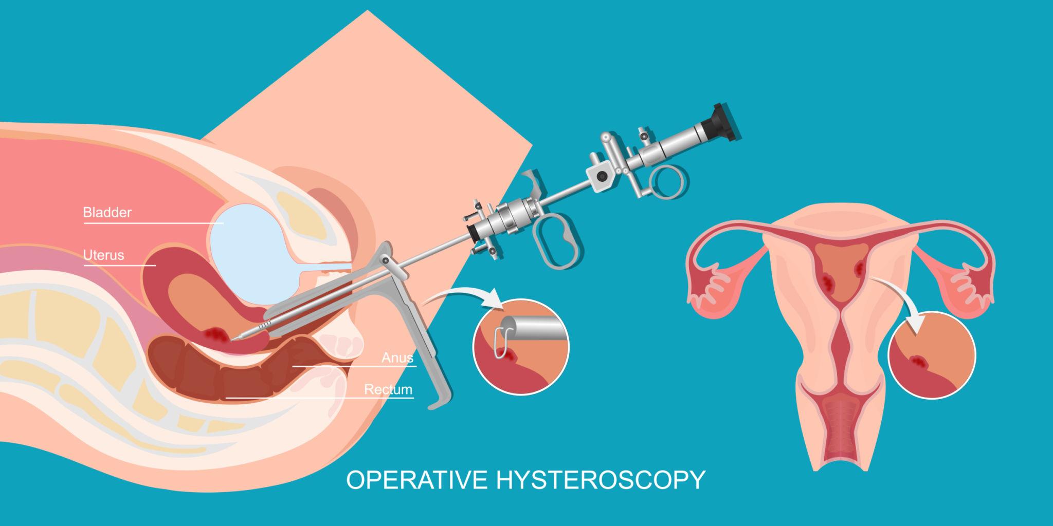 Hysteroscopic Septum Resection in Pune – Advanced Treatment for Uterine Septum